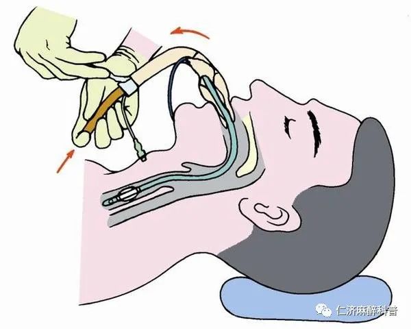 插管技术新突破，第210期动态图解析与临床应用探讨插管动态2560